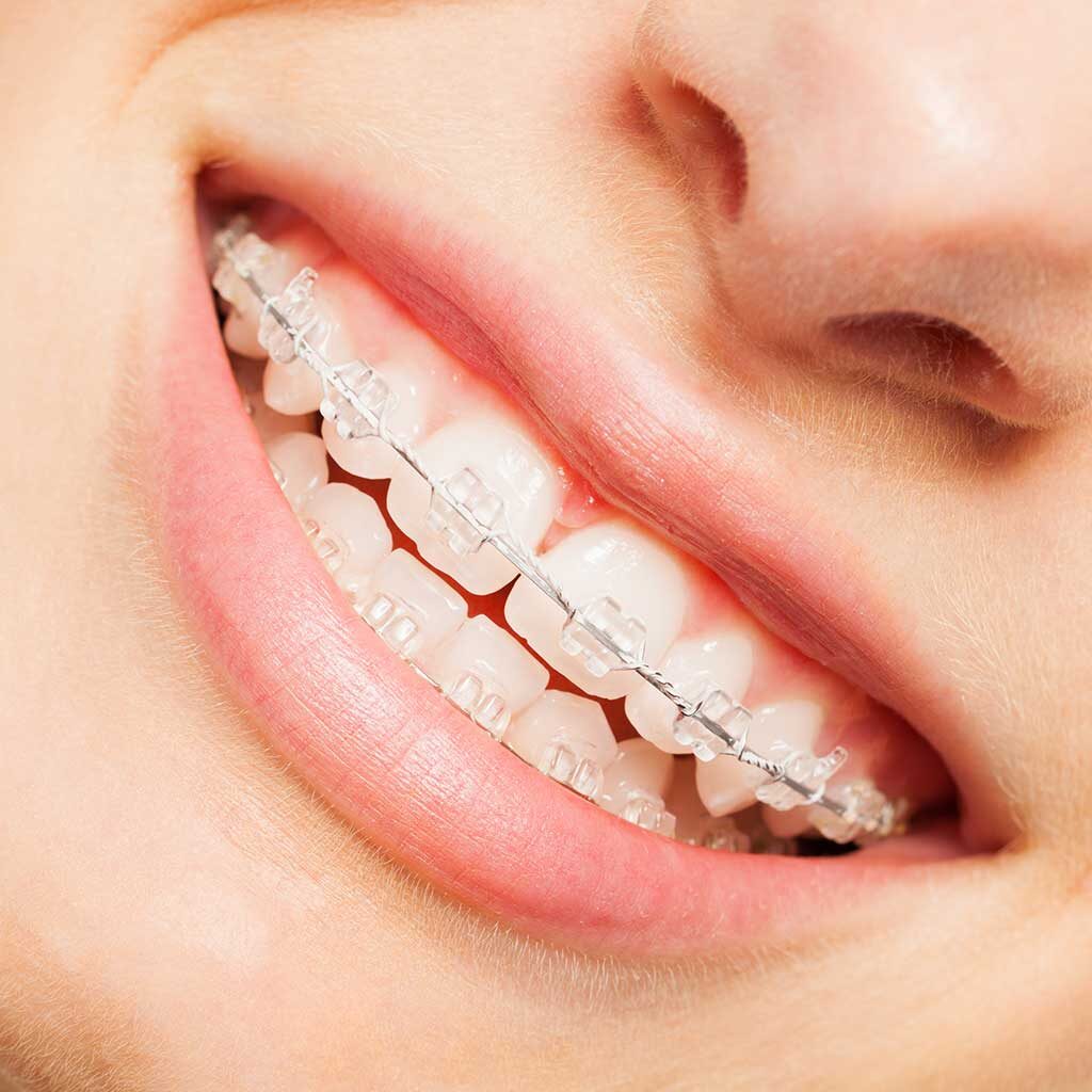 Clear metal deals braces